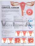 Understanding Cervical Cancer Anatomical Chart